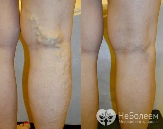 Condição das pernas antes e depois do tratamento a laser de veias varicosas