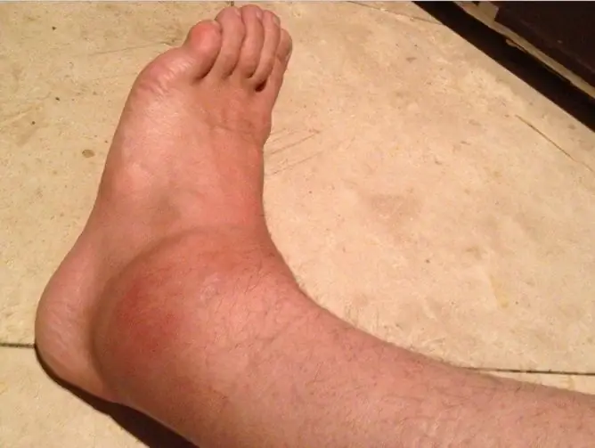 Swelling Of The Legs In The Ankle And Foot: Causes And Treatment At Home