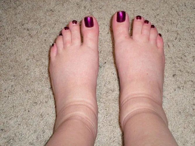 How To Quickly Remove Swelling From The Legs At Home: Tips, Video