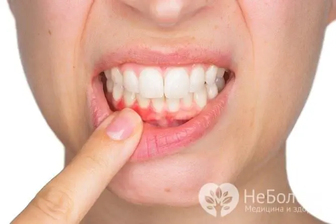 Pembengkakan gusi biasanya disebabkan oleh gingivitis, yang boleh dikaitkan dengan pelbagai sebab