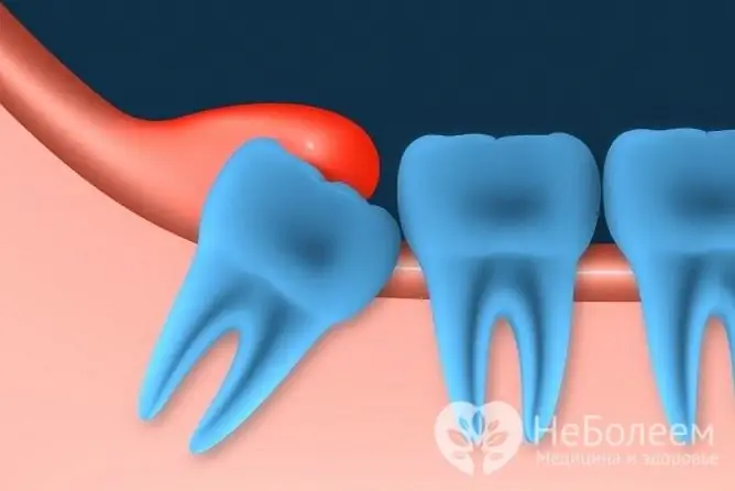 Eruption of a wisdom tooth can be painful and accompanied by swelling of the gums due to improper tooth placement