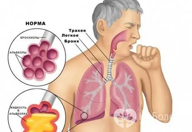 With a dry cough, the sputum is not separated, and with a wet cough, it is separated