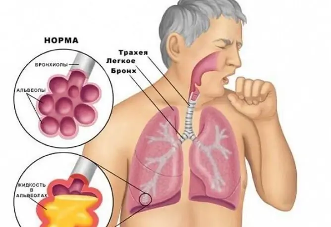 Cum Se Disting Tuse Uscată De Tuse Umedă La Copii și Adulți