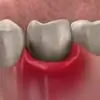 Swollen Gums