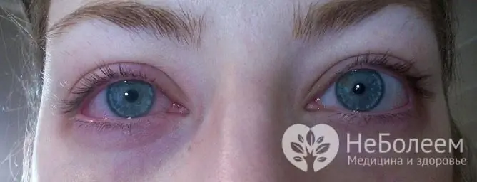 Avec les allergies, la toux est souvent accompagnée de larmoiements, d'écoulement nasal clair, de démangeaisons cutanées