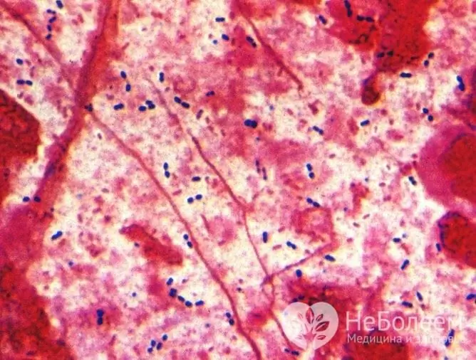 In 90% of cases of community-acquired pneumonia, the causative agent of the disease is bacteria, in particular pneumococcus