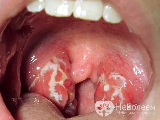 With angina, the tonsils increase significantly in size