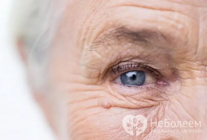 Persistently high intraocular pressure, especially in old age, may indicate glaucoma