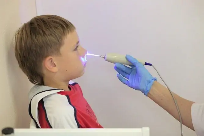 Tratamentul Cu Laser Al Adenoizilor La Copii (terapia Cu Laser): Recenzii, Video