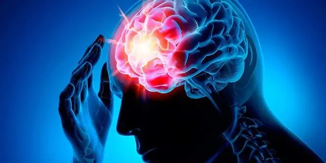 Signos De Un Accidente Cerebrovascular En Los Hombres: Síntomas, Los Primeros Signos De Un Micro Accidente Cerebrovascular