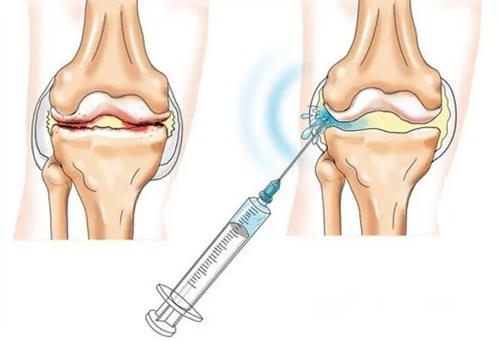 Hyaluronic acid injections into the joint