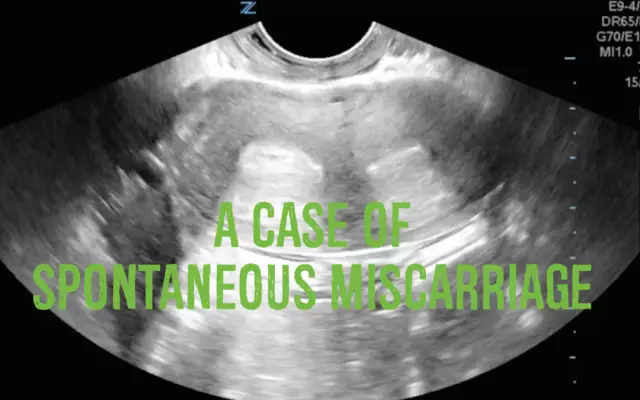 Early Spontaneous Miscarriage