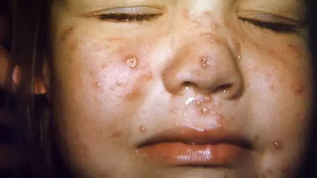 Chickenpox In Adolescents - Symptoms, Possible Complications, Treatment