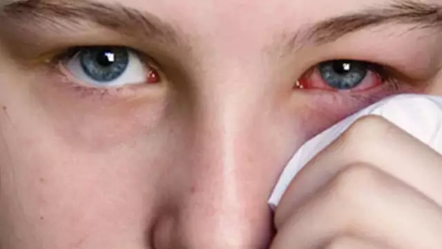 Conjunctivitis In Children, Treatment