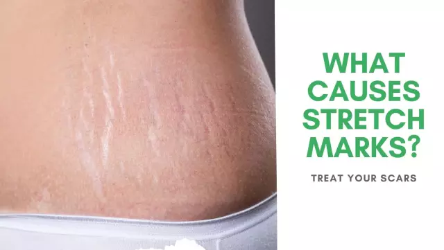 Stretch Marks In Adolescents - Causes, Treatment Methods, Folk Recipes