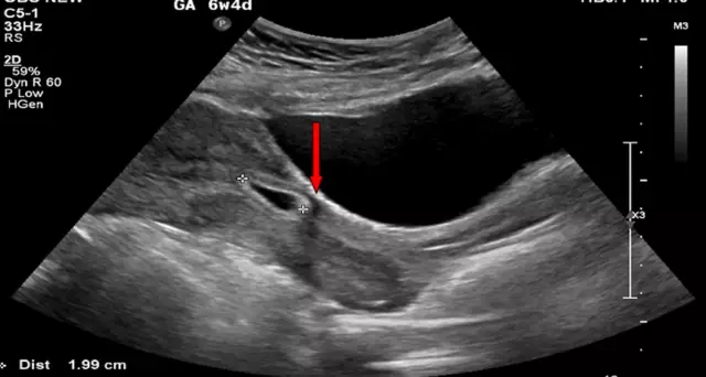 Menstruation After An Ectopic Pregnancy