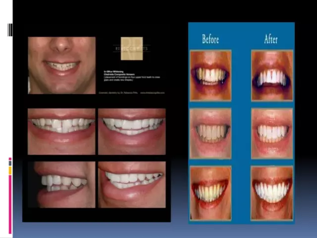 Teeth Veneers - Types, Indications For Use, Advantages And Disadvantages, Reviews, Before And After