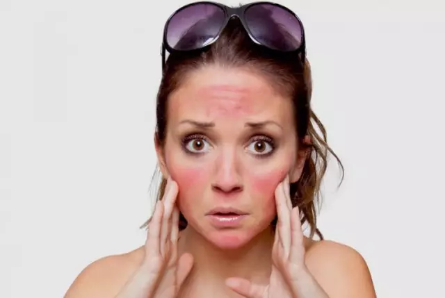 How To Whiten Your Face From Sunburn - Remedies And Problems