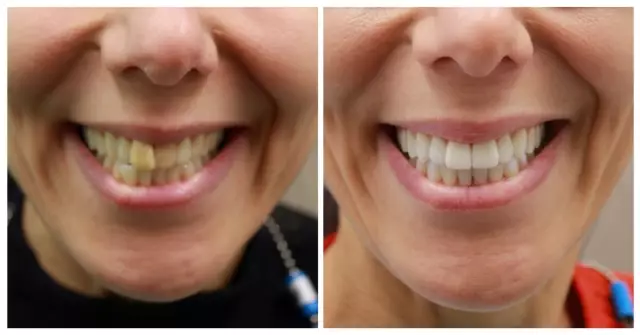 Teeth Whitening - Means, Methods, Reviews