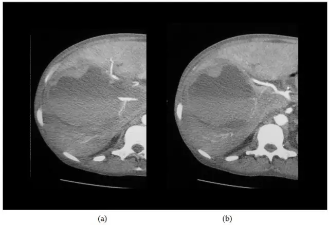 Puncture Liver Biopsy - Results, Complications