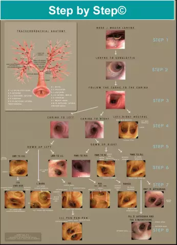 Bronchoscopy - Indications, Complications