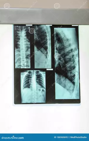 X-ray Of The Chest, Spine, Joints