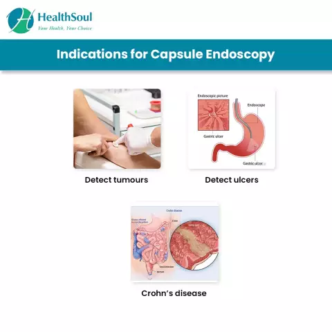 Sigmoidoscopy - Indications, Complications, Preparation