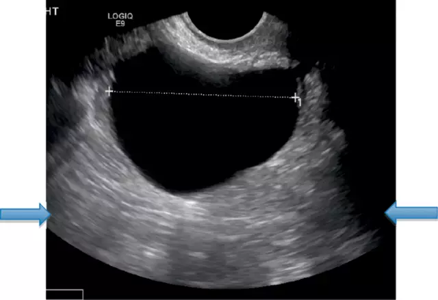 Ultrasound Of The Uterus - Features, Results