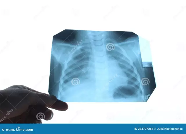 Fluorography Of The Lungs - Indications, Decoding