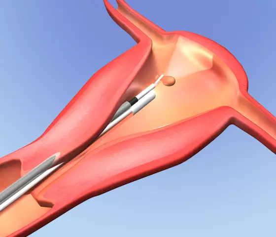 Hysteroscopy - Indications, Technique, Complications