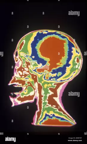 Brain Tomography - Indications, Methods