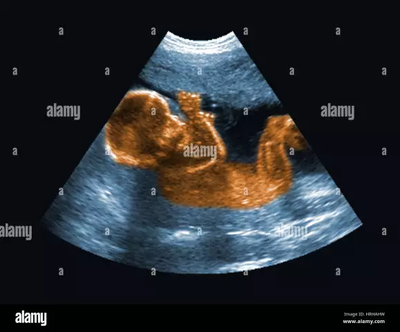 Ultrasound Of The Fetus - Indications For Conduct, Types, Decoding, Indicators