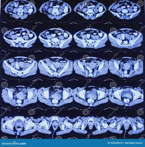 Oncocytology Of The Cervix - Results, Method