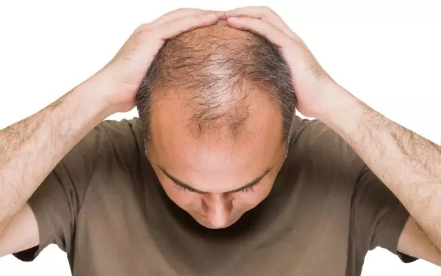 Androgenic Alopecia In Women - Treatment, Prognosis