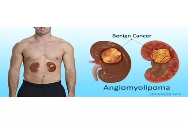 Angiomyolipoma - Causes, Symptoms, Treatment