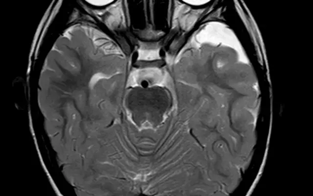 Arachnoid Cyst - Causes, Symptoms, Diagnosis, Treatment