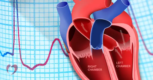 Atrioventricular Block - Causes, Types, Treatment