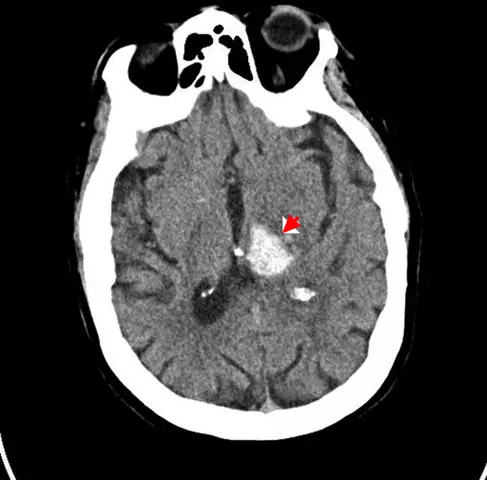 Intracranial Hematoma - Treatment, Types, Symptoms