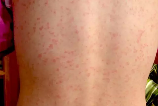 Scarlet Fever - Causes, Symptoms, Types, Treatment, Complications