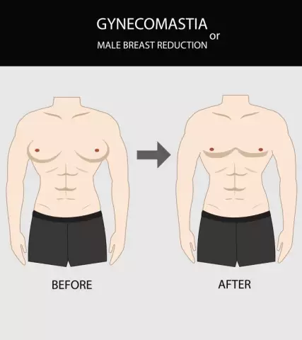 Gynecomastia - Causes, Symptoms, Diagnosis, Treatment