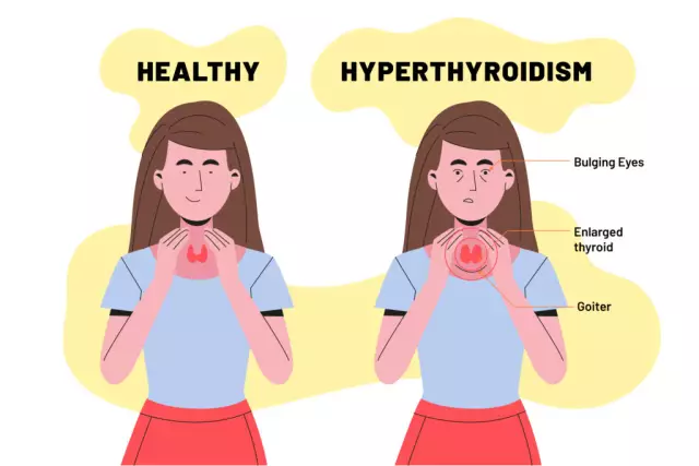 Hypothyroidism - Symptoms, Treatment, Prognosis