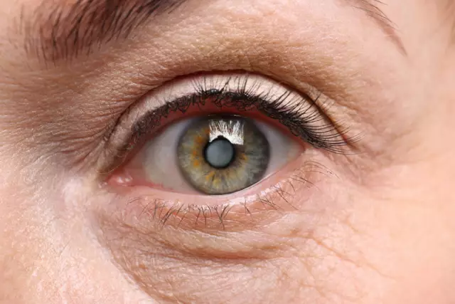 Cataract - Causes, Symptoms, Treatment, Removal, Complications