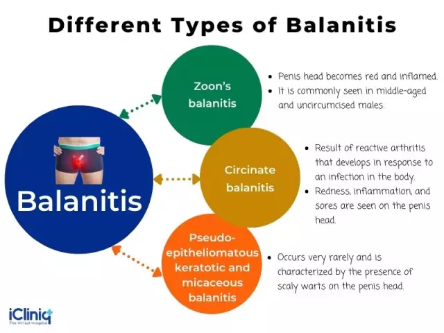 Balanitis - Treatment, Symptoms, Prognosis