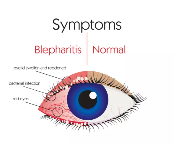 Blepharitis - Treatment, Symptoms, Causes