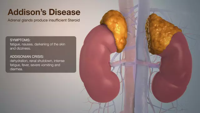 Addison's Disease: Symptoms, Treatment, Diagnosis, Photos, Causes