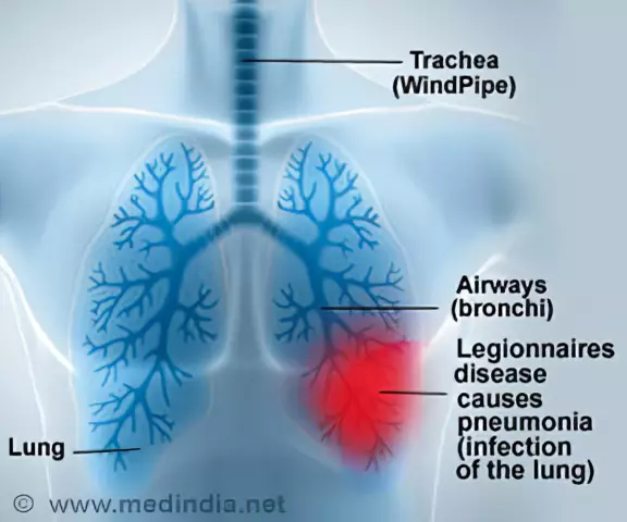 Legionnaires' Disease - Description, Symptoms, Course