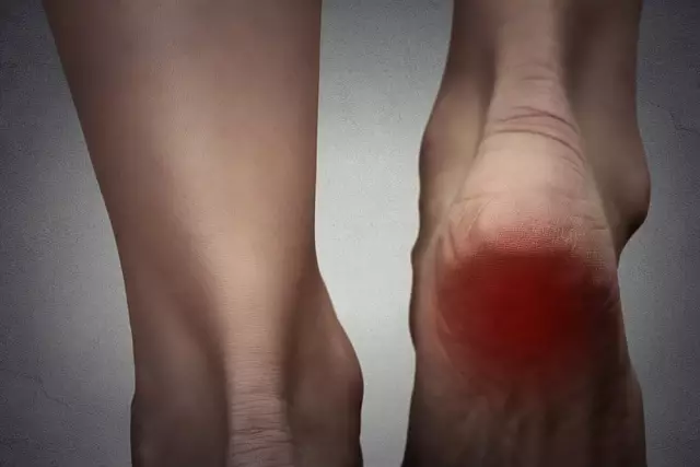 Joint Bursitis - Treatment, Symptoms, Diagnosis