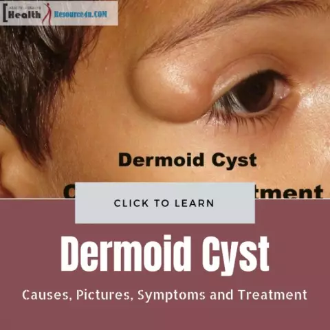 Dermoid Cyst - Causes, Treatment, Removal