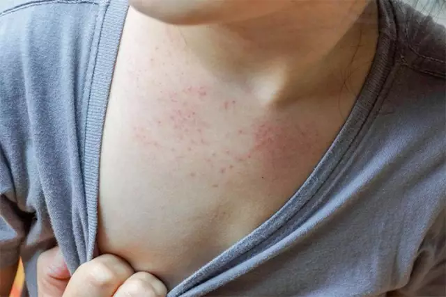 Children's Roseola - Causes, Symptoms, Treatment