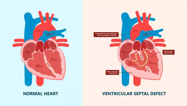 Atrial Septal Defect - Symptoms, Treatment, Forms, Stages, Diagnosis